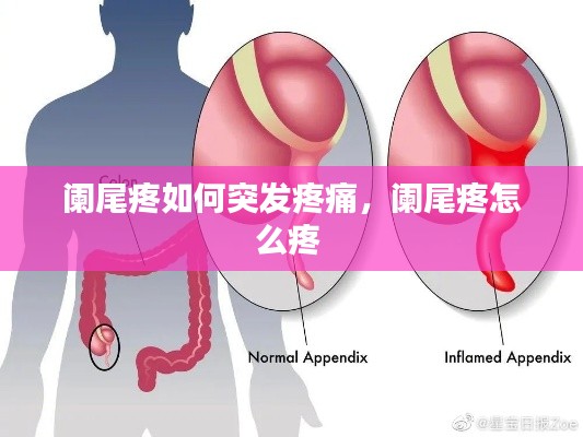 阑尾疼如何突发疼痛,阑尾疼怎么疼